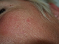 Keratose 1-2 - - laser medical - esthetique