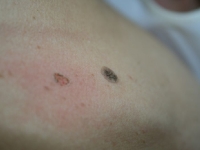Verrue seborrheique - - laser medical - esthetique