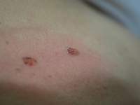 Verrue seborrheique - laser medical - esthetique