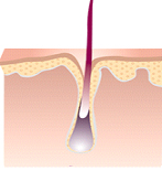 esthetique à nice - epilation definitive - lumière pulsée et laser