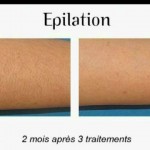 Esthetique à nice - epilation definitive - lumière pulsée et laser