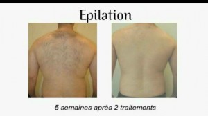 Esthetiquqe à Nice - épilation homme: épilation du dos 