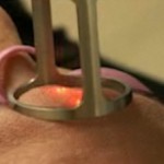 Traitement des affections cutanéées bénignes avec le laser fractionné