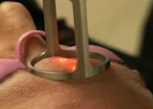 Esthetique à nice - epilation definitive - lumière pulsée et laser - resurfacing