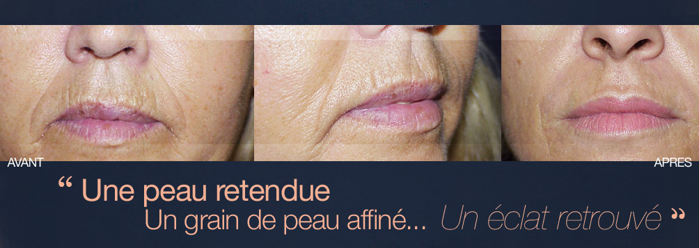 Laser esthétique à Nice - Resurfacing - Peeling - Rajeunissement - Rides et Comblement